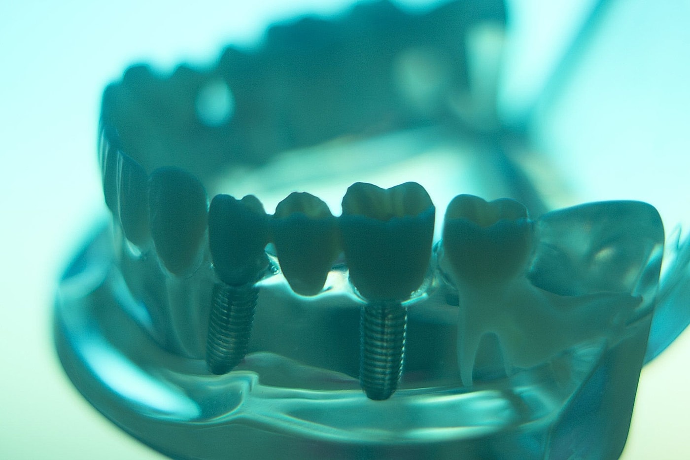 Modello di arcata dentale con impianti avvitati sull'osso