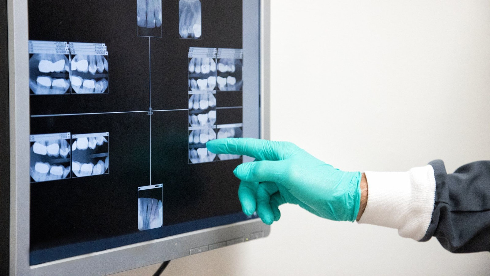 Radiografia panoramica delle arcate osservata su diafanoscopio